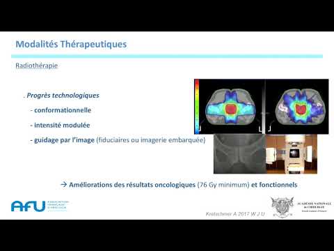 Vidéo: Le Rôle De La Cystoprostatectomie Dans La Gestion Du Cancer De La Prostate Localement Avancé: Une Revue Systématique