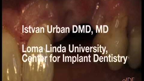 CV-25-01 Simultaneous Vertical Hard and Soft Tissue Augmentation PREVIEW