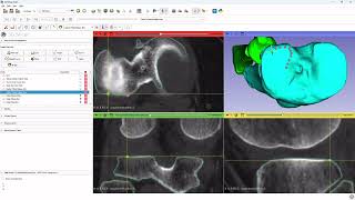 Tutorial 8 3D Slicer New method tibial plateau and plafond
