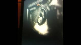 Sandras Baby Ultrasound