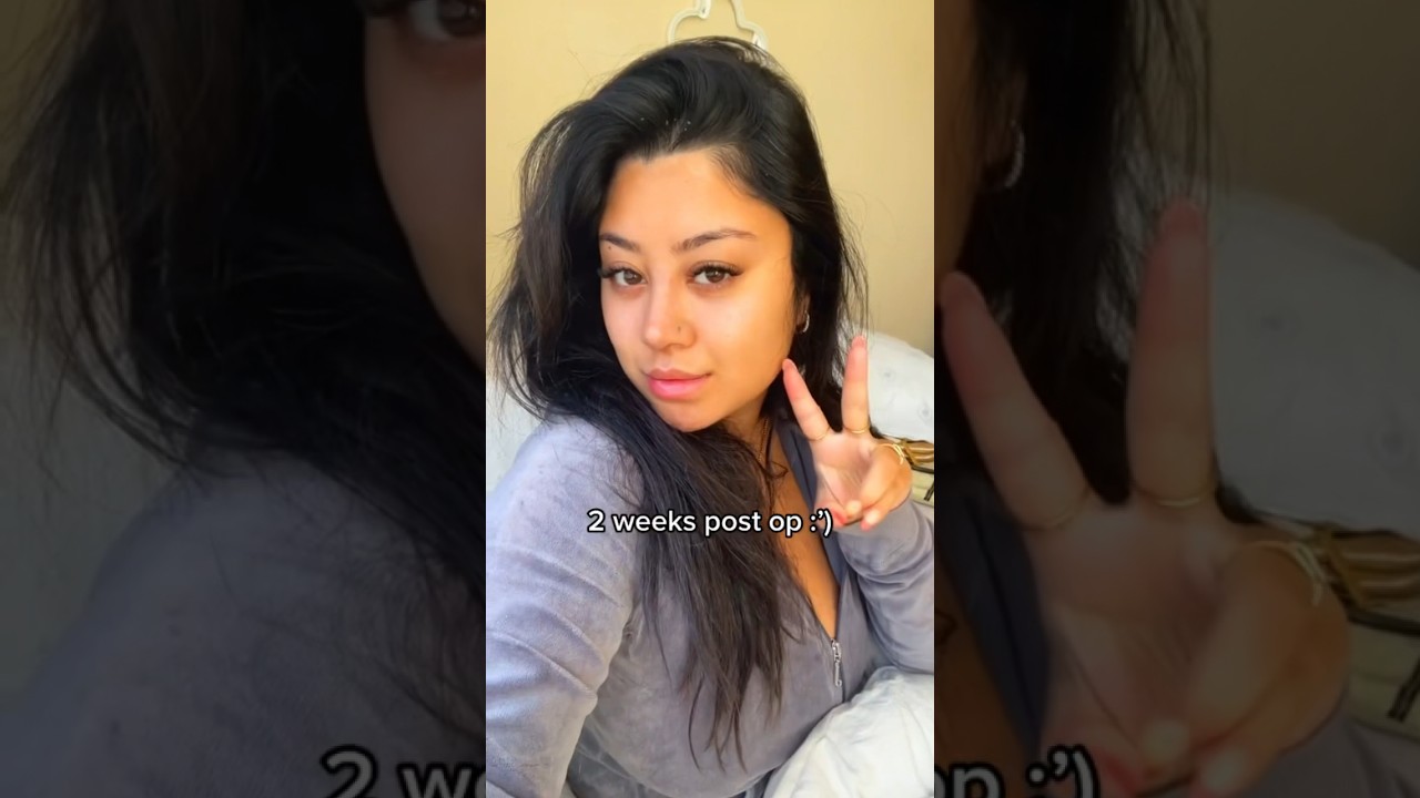 My Turkish nose job journey :) 