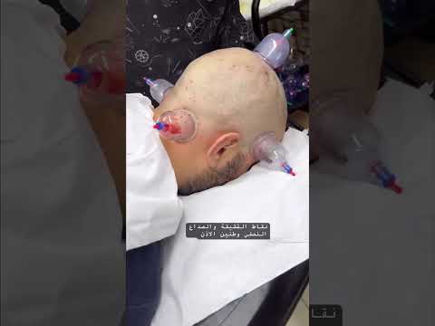 علاج الشقيقة والصداع النصفي وطنين الاذن الحجامة المغرب