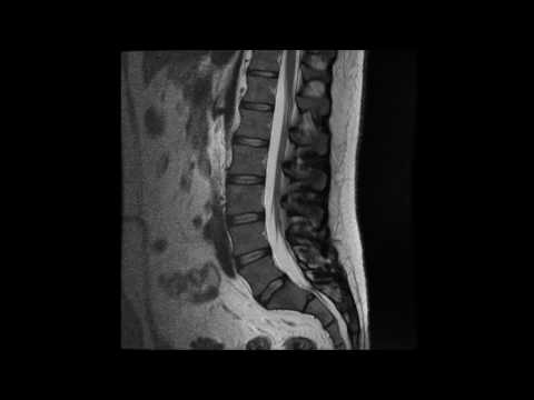 MR undersøkelse av normal korsrygg (Normal lumbal columna)