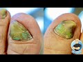 HER TOENAILS ARE TOO THICK AND HARD TO CUT!!! ***HOW TO TREAT DAMAGED TOENAILS***