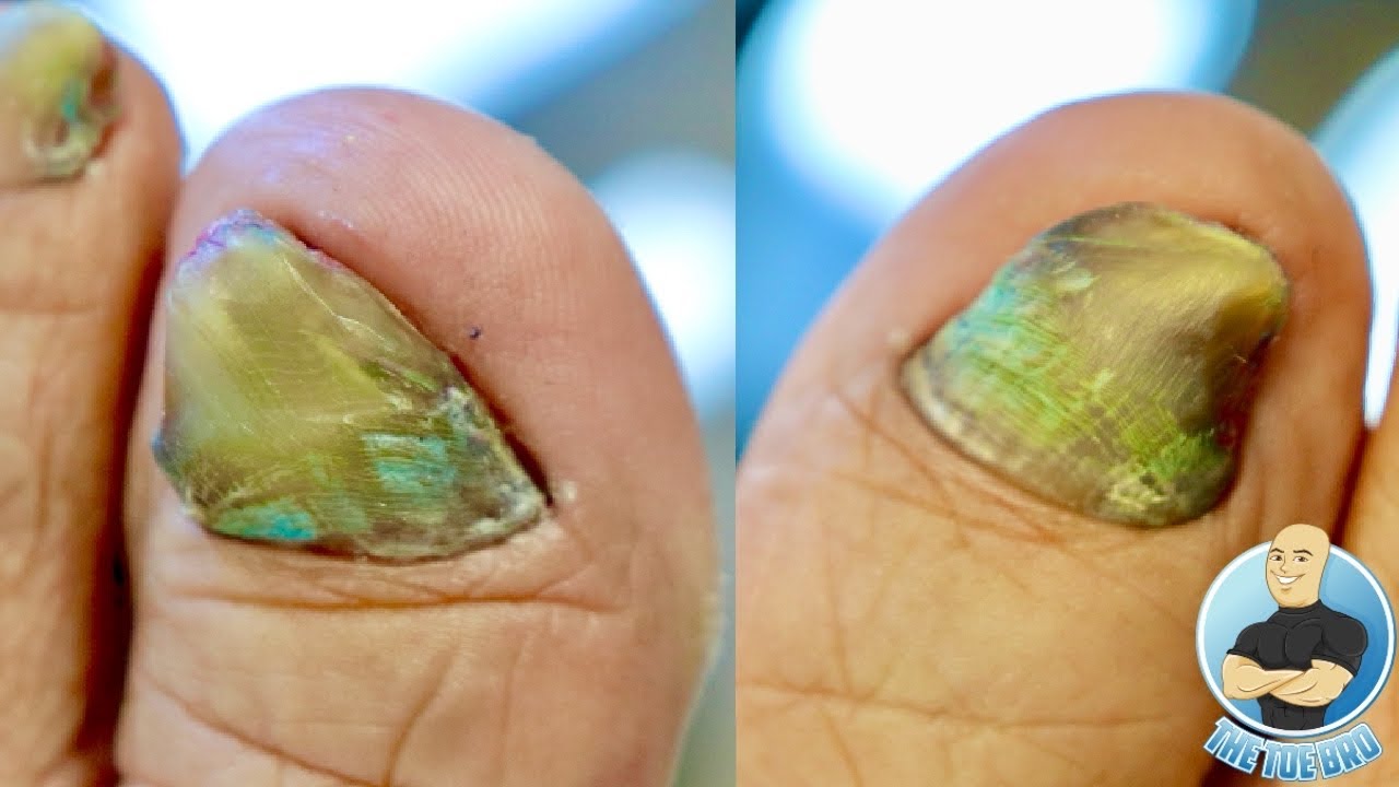 Toenail Problems: Symptoms, Causes, and Treatments