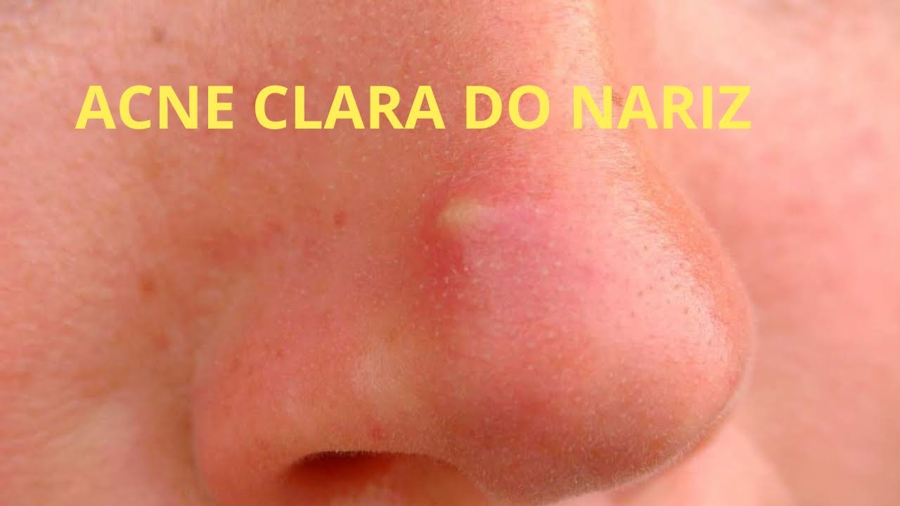 Espinhas de nariz claras | 맑은 코 여드름 | Clear nose acne - YouTube
