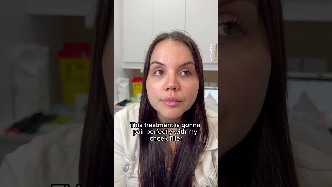 Bridal Under Eye Filler Treatment at Skin Vitality - Book Tear Trough Filler (Toronto 416-969-9669)!