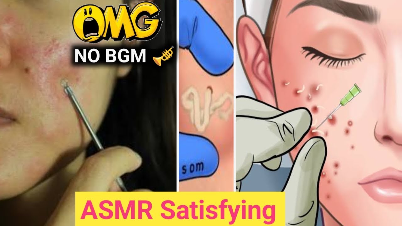 ASMR Makeup Acne Removal Animation Pimple Popping Relaxin Video #2