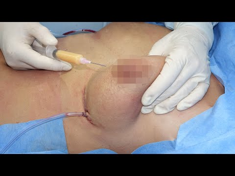 Video: Thali García U Kupaćem Kostimu Nakon Uklanjanja Implantata S Dojke