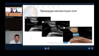 Осложнения лучевой терапии рака  простаты