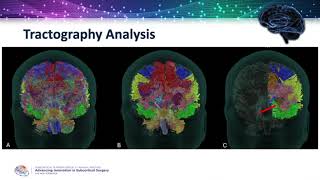 Comparative Analysis between Tubular Retractor & Open Craniotomy Surgery Using MRI Tractography