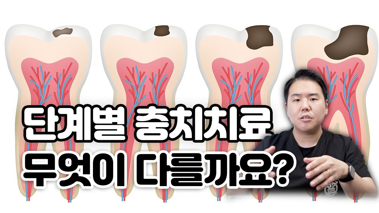 다같은 치료가 아니다! 단계에 따른 충치 치료를 알려드립니다