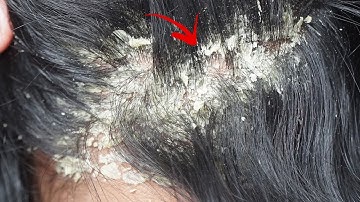 Dandruff Shampoo and Scratching, Itchy Dry Scalp, Huge Flake - Psoriasis #48