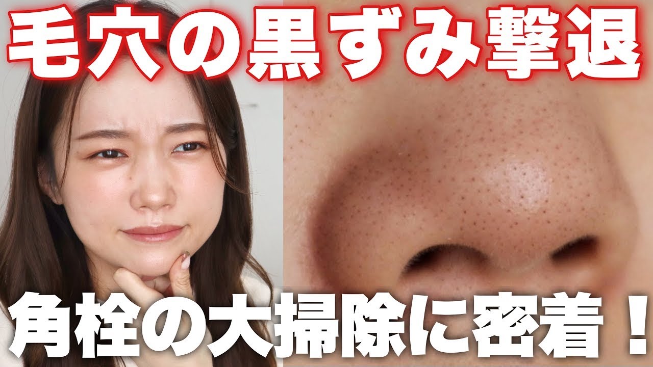 背中の黒ずみは絞ったほうがいいですか?