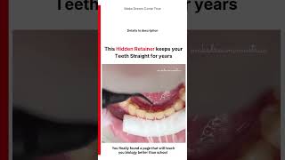 🦷 This Hidden Retainer keeps 🪡 your Teeth Straight for Years 🧑⚕️ | MDCT