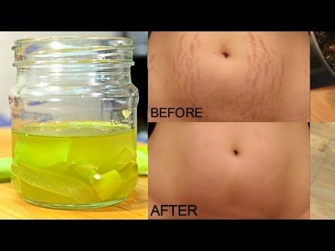 How To Remove Stretch Marks Permanently Works 100% - Cure Injury & Burn In 3 Days Miracle Oil