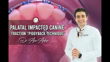 treatment of impacted canine, step by step piggyback double wire mechanics