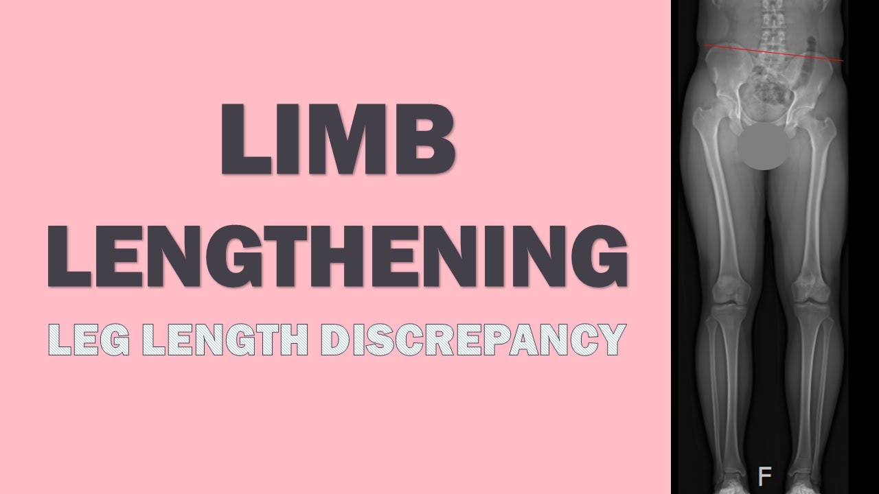 limb-lengthening-for-leg-length-discrepancy-it-was-way-easier-than-i