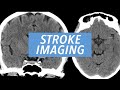 Imaging findings of the acute ischemic stroke ct cta and mri brain exams reviewed