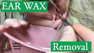 HUGE Earwax (Cerumen) Removal with Forceps | Auburn Medical Group