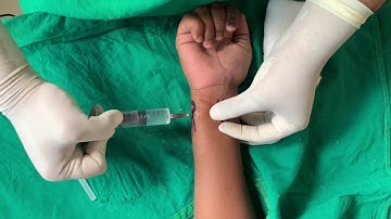 Nerve Block of the Wrist Region for Regional Anaesthesia of the Hand