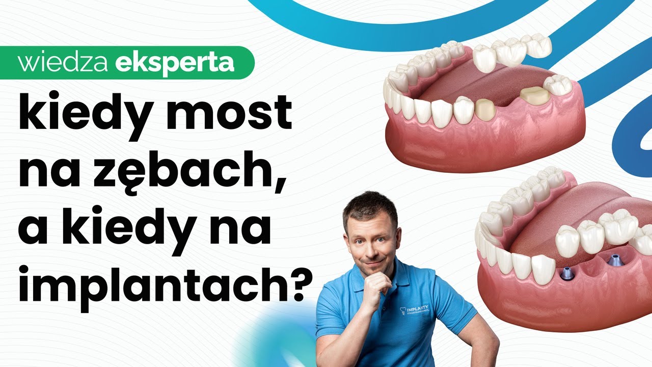 MOSTY NA IMPLANTACH. KIEDY MOST NA ZĘBACH, A KIEDY NA IMPLANTACH? ZALETY MOSTÓW NA IMPLANTACH.