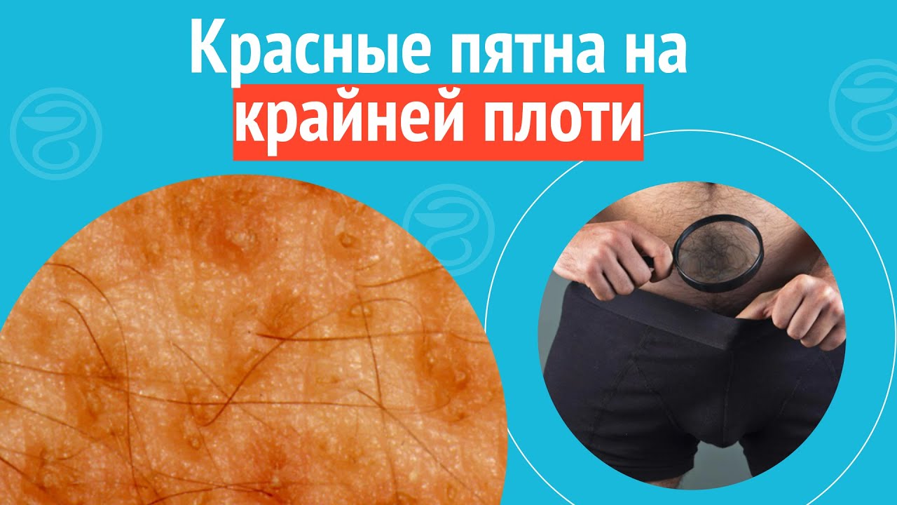 После Секса Покраснела После Секса Покраснела
