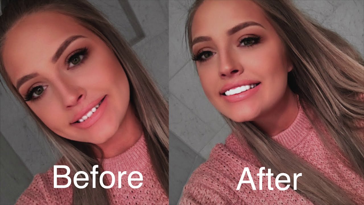 I got Veneers Removable Veneers USA YouTube