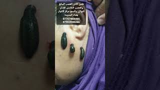 طنين الاذن العصب السابع والعصب الخامس فقدان التوازن والسمع 07707884455/07903500266