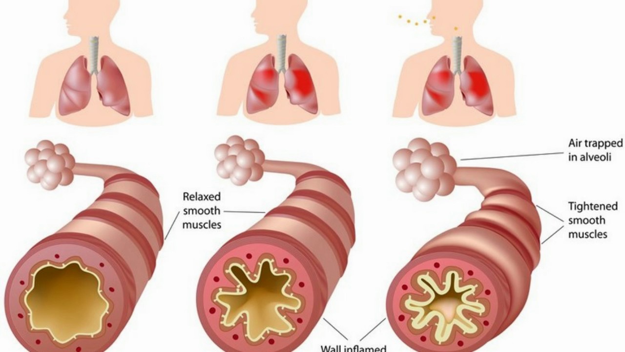 Image result for Chronic bronchitis and emphysema