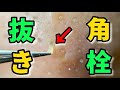 【スッキリ】鼻の角栓を抜く まとめ Blackheads