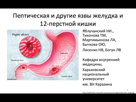 Пептическая и другие язвы желудка и 12 перстной кишки
