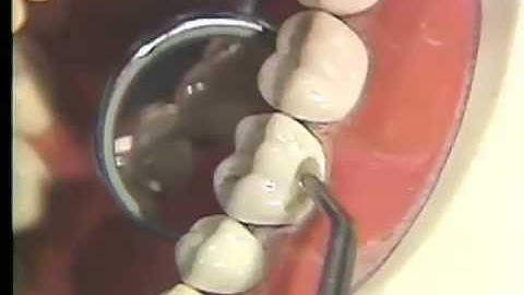 Packing and Carving of Class I and V Amalgam for Hygienists