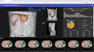 Cloud-based explainable AI (X-AI) system for liver cancer