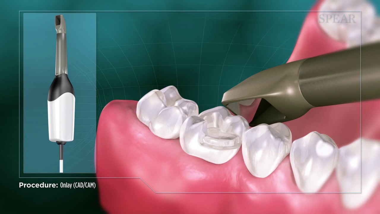 Onlay (CADCAM).flv - YouTube