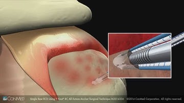 ConMed Linvatec Single Row Rotator Cuff Repair Using the Y Knot® RC Anchor Surgical Technique Anim
