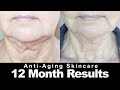 Affordable Anti-Aging Skincare - 12 Month Results Before & After