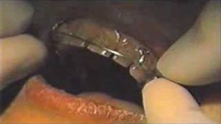 Keyhole Loop