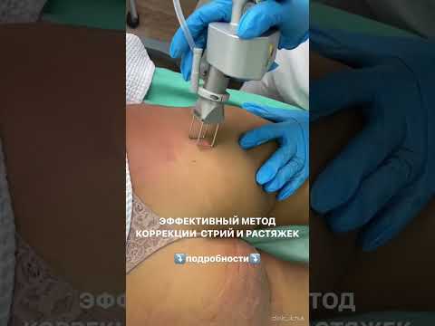 Стрии и растяжки на коже больше не ваша проблема!
