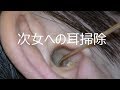 【耳掃除】次女の耳　匠の技を試す　earwax