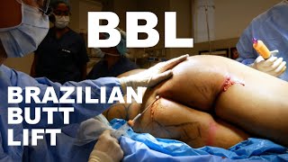 Brazilian Butt Lift (BBL) - Dr. Paul Ruff | West End Plastic Surgery