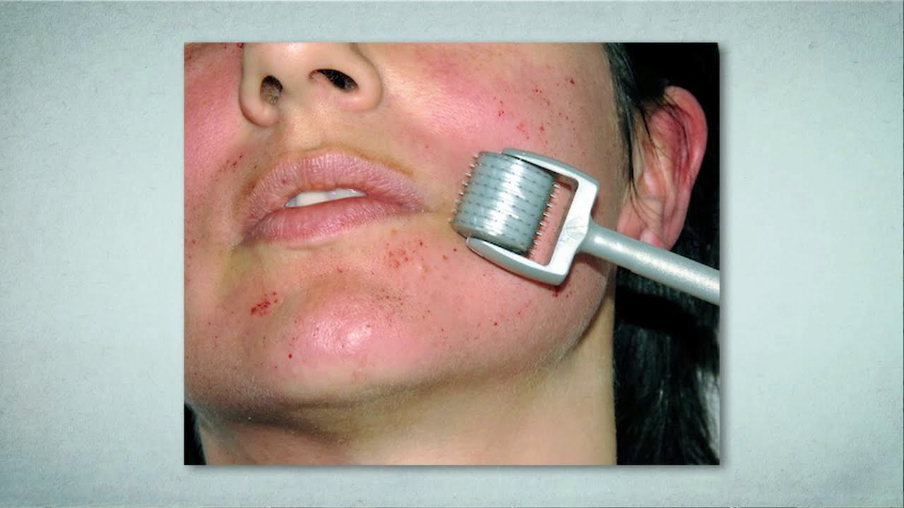 [Clip] ศิริราช The Life : ชัดๆ เอา Derma Roller นวดหน้า หลุมสิวไม่หาย แถมโอกาสติดเชื้อสูง