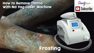 How to Remove Tattoo With Nd Yag Laser Machine - Beauty Channel IND