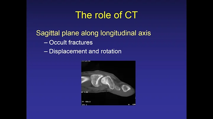 Acute scaphoid fracture management - Session 8 - 13h30 - Grant Biddulph