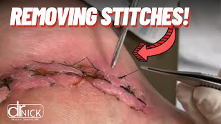 Expert Insights on Removing Stitches | Does it Hurt?!😳😬