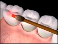 Gaspari family dental shares an illustration about lanap in bethlehem pa