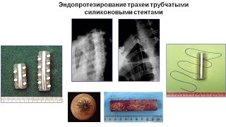 Лекция: Рубцовый стеноз трахеи. To stent or not to stent? (Базаров Д.В., РНЦХ)