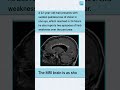 Multiple Sclerosis Clinical Clue You Can’t Miss | FMGE NEET PG