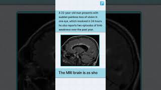 Multiple Sclerosis Clinical Clue You Can’t Miss | FMGE NEET PG