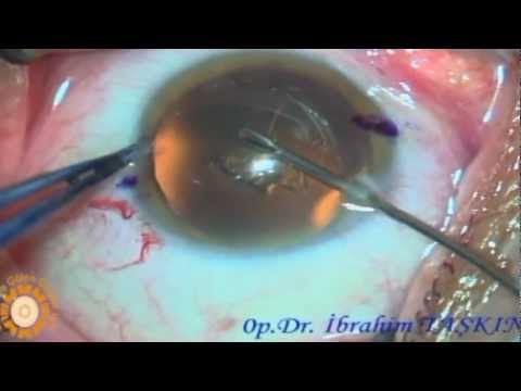 Refraktif Multifokal torik lens değişimi,  Op.Dr. İbrahim TAŞKIN, ADANA MAYA GÖZ.mpg